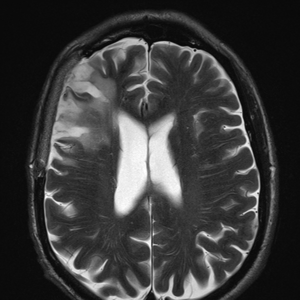 File:Anaplastic meningioma with recurrence (Radiopaedia 34452-35788 Axial T2 17).png