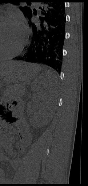 File:Aneurysmal bone cyst T11 (Radiopaedia 29294-29721 Sagittal bone window 6).jpg