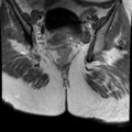 Ano-vaginal fistula (Radiopaedia 29765-30284 Coronal T1 C+ 16).jpg