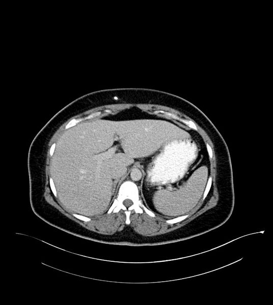 File:Anterior abdominal wall CSF pseudocyst (CSFoma) (Radiopaedia 79453-92571 A 24).jpg