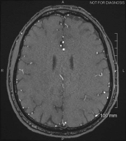 File:Anterior cerebral artery aneurysm (Radiopaedia 80683-94127 Axial MRA 169).jpg