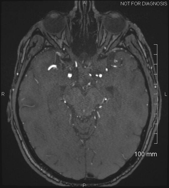 File:Anterior cerebral artery aneurysm (Radiopaedia 80683-94127 Axial MRA 98).jpg