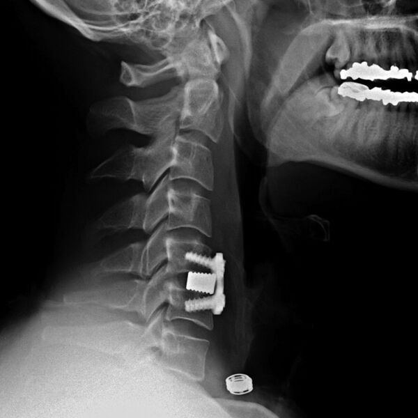 File:Anterior cervical discectomy and fusion (ACDF) subsidence (Radiopaedia 7196-72301 Lateral 1).jpg