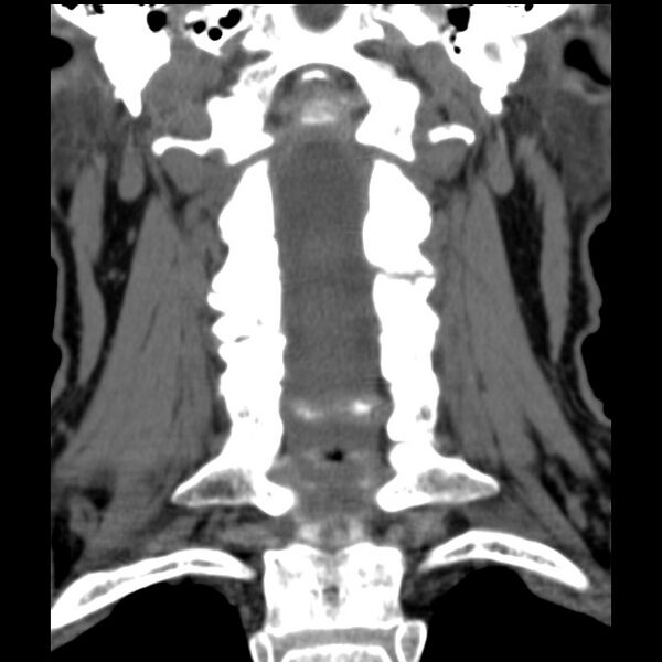 File:Anterior cervical postdiscectomy arthrodesis (Radiopaedia 32678-33646 Coronal non-contrast 17).jpg