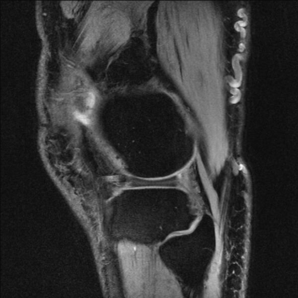 File:Anterior cruciate ligament mucoid degeneration (Radiopaedia 68400-77933 Sagittal 8).jpg