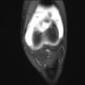 Anterior cruciate ligament tear - pediatric (Radiopaedia 62152-70260 Coronal PD fat sat 22).jpg
