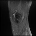 Anterior cruciate ligament tear with posteromedial corner injury, bucket-handle meniscal tear and chondral delamination (Radiopaedia 75501-86744 Sagittal PD fat sat 2).jpg