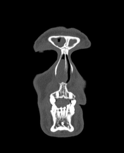 File:Antrochoanal polyp (Radiopaedia 79011-92169 Coronal bone window 82).jpg
