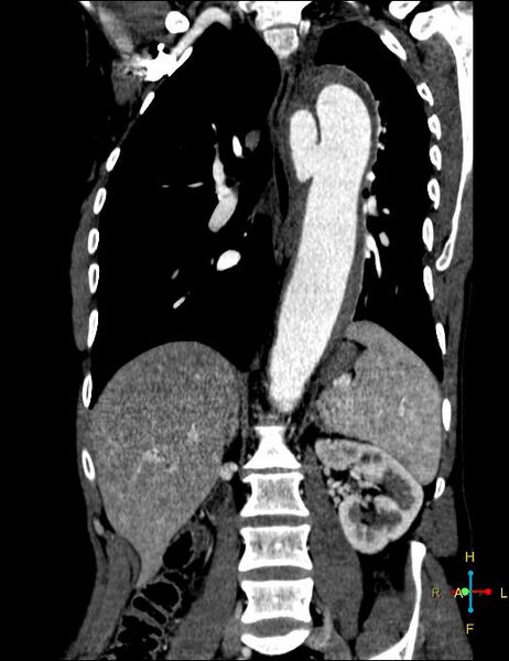 File:Aortic aneurysm and penetrating ulcer (Radiopaedia 23590-23704 B 13).jpg