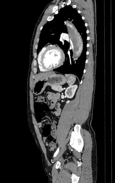 File:Aortic dissection - Stanford type A (Radiopaedia 83418-98500 B 64).jpg