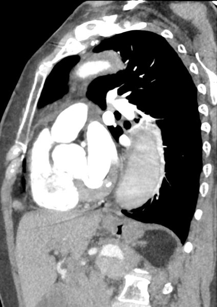 File:Aortic dissection - Stanford type B (Radiopaedia 50171-55512 C 21).png