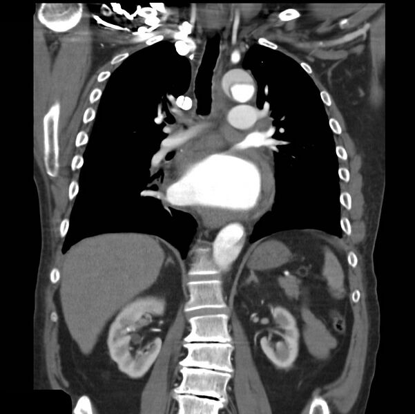 File:Aortic dissection with rupture into pericardium (Radiopaedia 12384-12647 B 25).jpg