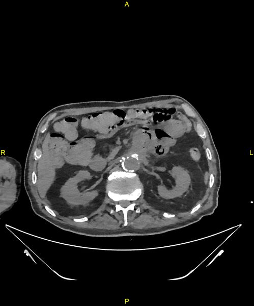 File:Aortoenteric fistula (Radiopaedia 84308-99603 Axial non-contrast 116).jpg