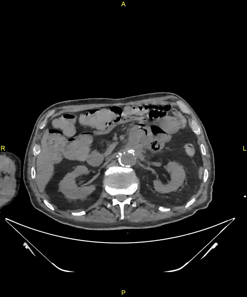 Aortoenteric fistula (Radiopaedia 84308-99603 Axial non-contrast 116).jpg