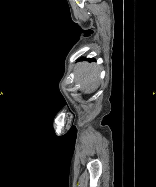 File:Aortoenteric fistula (Radiopaedia 84308-99603 C 26).jpg