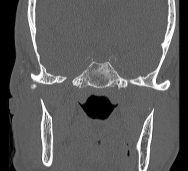 File:Aplastic maxillary sinuses (Radiopaedia 60030-67561 Coronal non-contrast 37).jpg