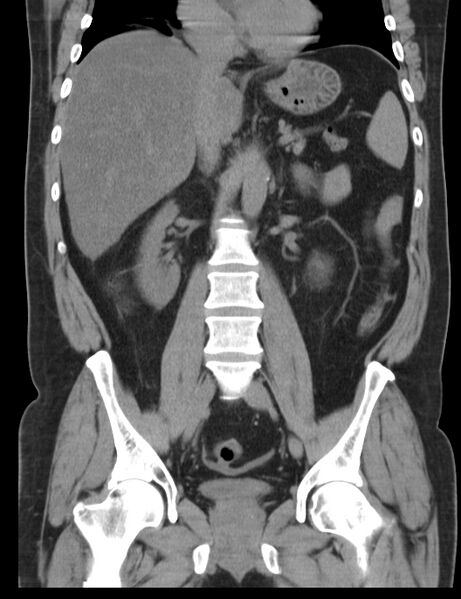 File:Appendicitis and giant appendicolith (Radiopaedia 80251-93588 Coronal non-contrast 26).jpg