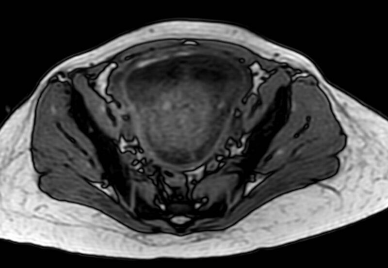 File:Appendicitis in gravida (MRI) (Radiopaedia 89433-106395 D 57).jpg