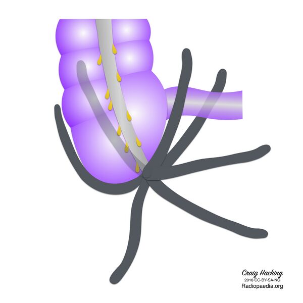 File:Appendix position (diagram) (Radiopaedia 62911-71293 B 1).jpeg