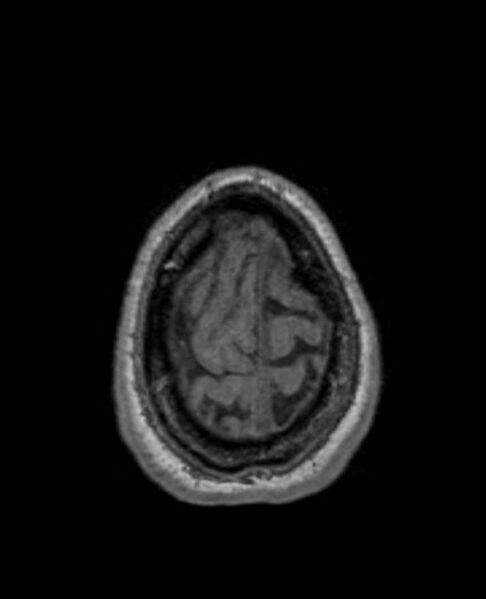 File:Arachnoid cyst- extremely large (Radiopaedia 68741-78451 Axial T1 72).jpg