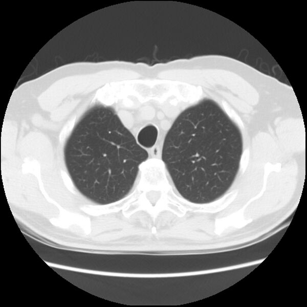 File:Asbestos-related pleural plaques (Radiopaedia 39069-41255 Axial lung window 13).jpg