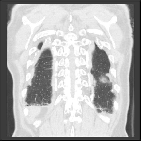 File:Asbestos-related pleural plaques (Radiopaedia 39069-41255 Coronal lung window 11).jpg