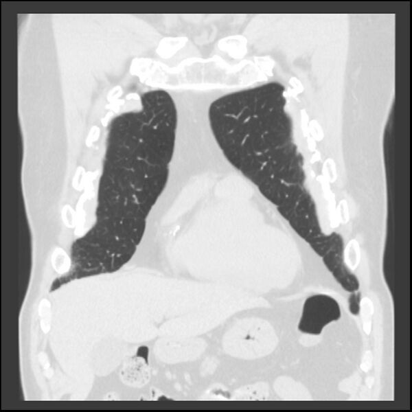 File:Asbestos-related pleural plaques (Radiopaedia 39069-41255 Coronal lung window 70).jpg