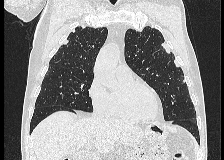 Asbestos pleural placques (Radiopaedia 57905-64872 Coronal lung window 82).jpg