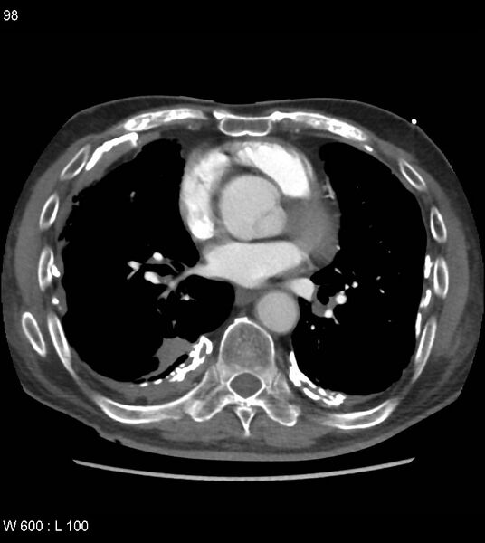 File:Asbestos related lung and pleural disease (Radiopaedia 14377-14301 D 34).jpg