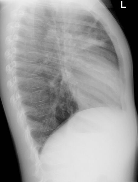 File:Asthma (Radiopaedia 17996-17760 Lateral 1).jpg