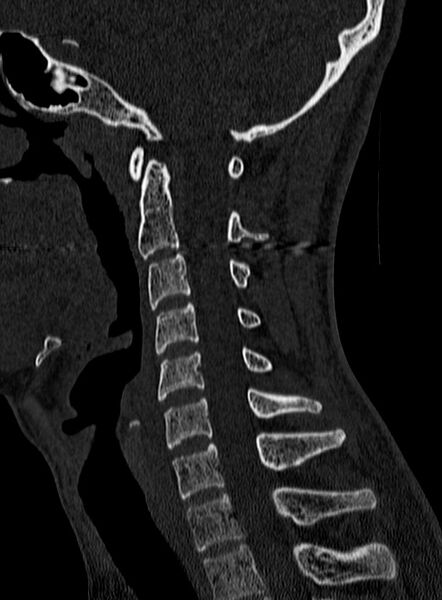 File:Atlantoaxial subluxation (Radiopaedia 44681-48450 Sagittal bone window 81).jpg
