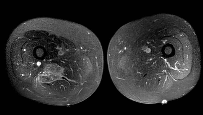 Atypical lipomatous tumor - thigh (Radiopaedia 68975-78734 Axial T1 C+ fat sat 55).jpg