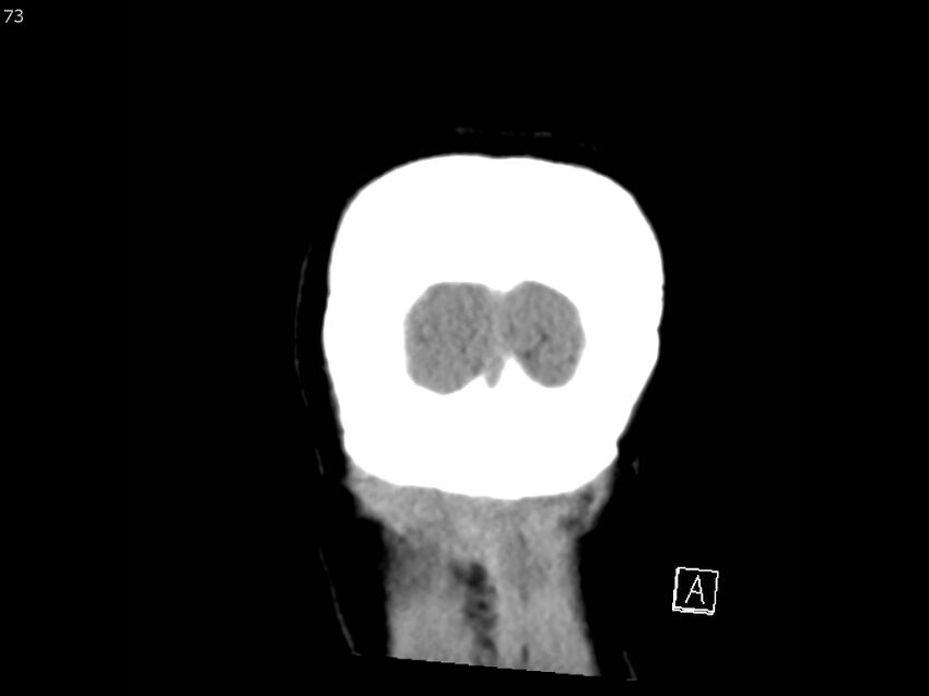 Atypical meningioma - intraosseous (Radiopaedia 64915-73867 B 72).jpg