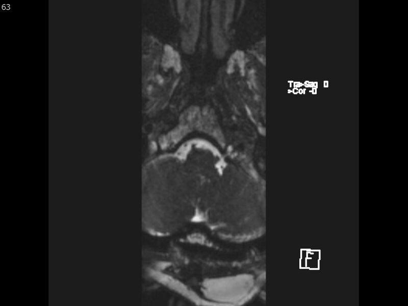 File:Atypical meningioma - intraosseous (Radiopaedia 64915-74572 Axial CISS 63).jpg