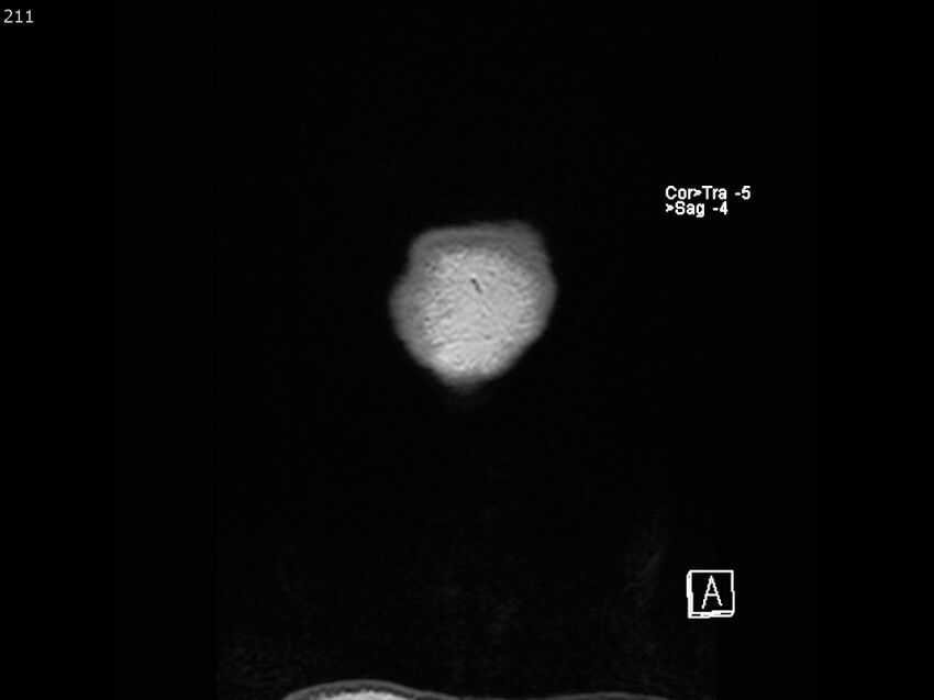 Atypical meningioma - intraosseous (Radiopaedia 64915-74572 Coronal T1 211).jpg