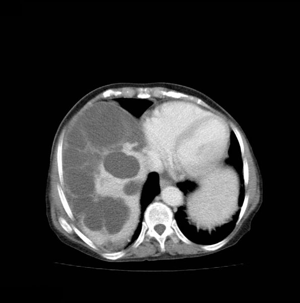 File:Autosomal dominant polycystic kidney disease (Radiopaedia 16777-16490 A 7).jpg