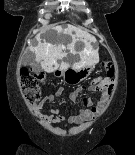 File:Autosomal dominant polycystic kidney disease (Radiopaedia 57124-64017 B 18).jpg