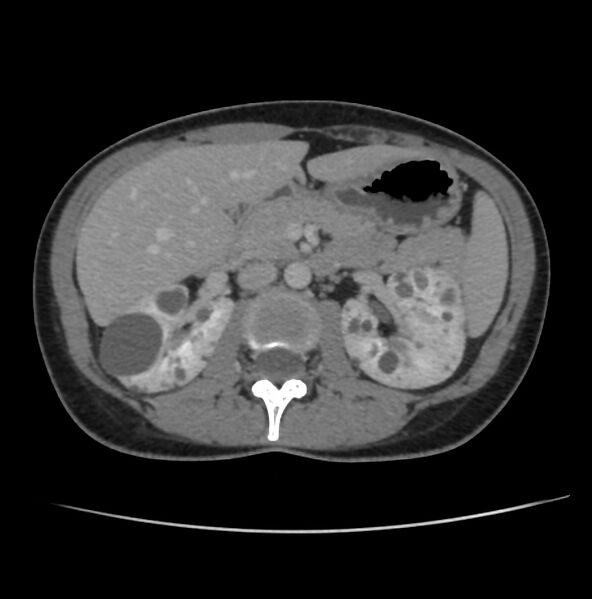 File:Autosomal dominant polycystic kidney disease - early onset (Radiopaedia 40734-43387 A 26).jpg