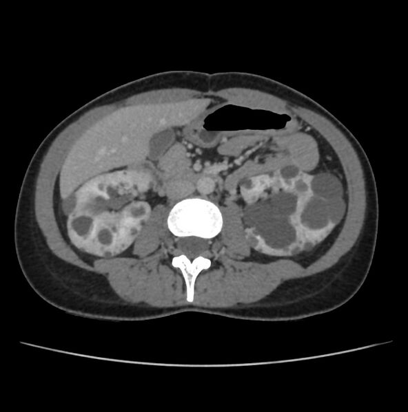 File:Autosomal dominant polycystic kidney disease - early onset (Radiopaedia 40734-43387 A 38).jpg