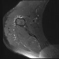 Avulsion fracture - greater tuberosity of humerus (Radiopaedia 71216-81515 Axial PD fat sat 3).jpg