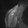 Avulsion fracture - greater tuberosity of humerus (Radiopaedia 71216-81515 Coronal PD fat sat 18).jpg