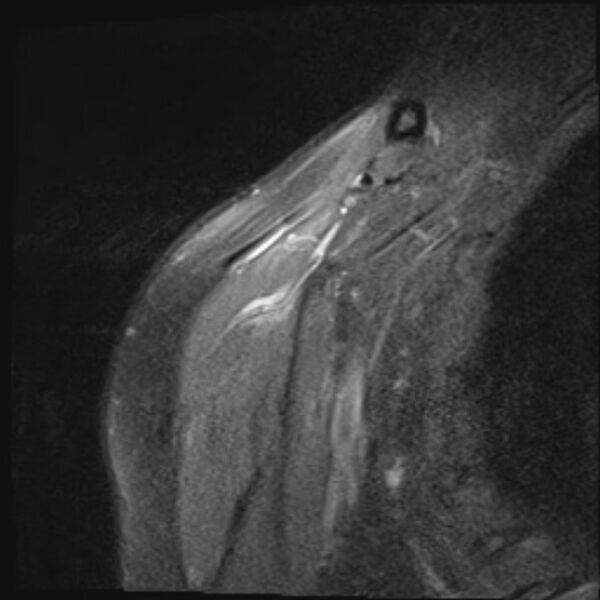 File:Avulsion fracture - greater tuberosity of humerus (Radiopaedia 71216-81515 Coronal PD fat sat 18).jpg