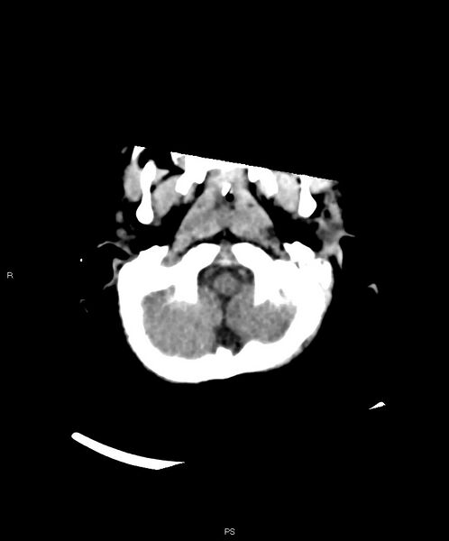 File:Basal ganglia and parenchymal ischemia (Radiopaedia 45818-50083 Axial non-contrast 40).jpg