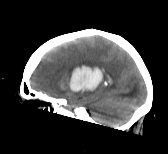 File:Basal ganglia hemorrhage (Radiopaedia 58759-65981 C 42).jpg