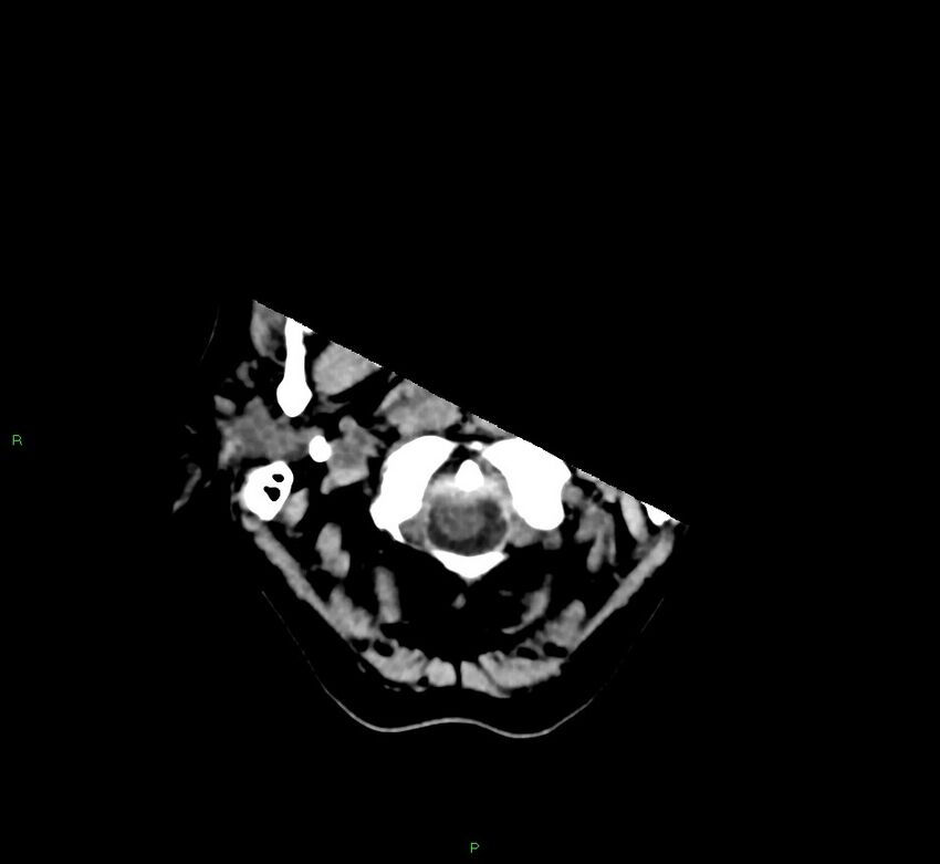 Basal ganglia hemorrhage (Radiopaedia 58775-66008 Axial non-contrast 54).jpg