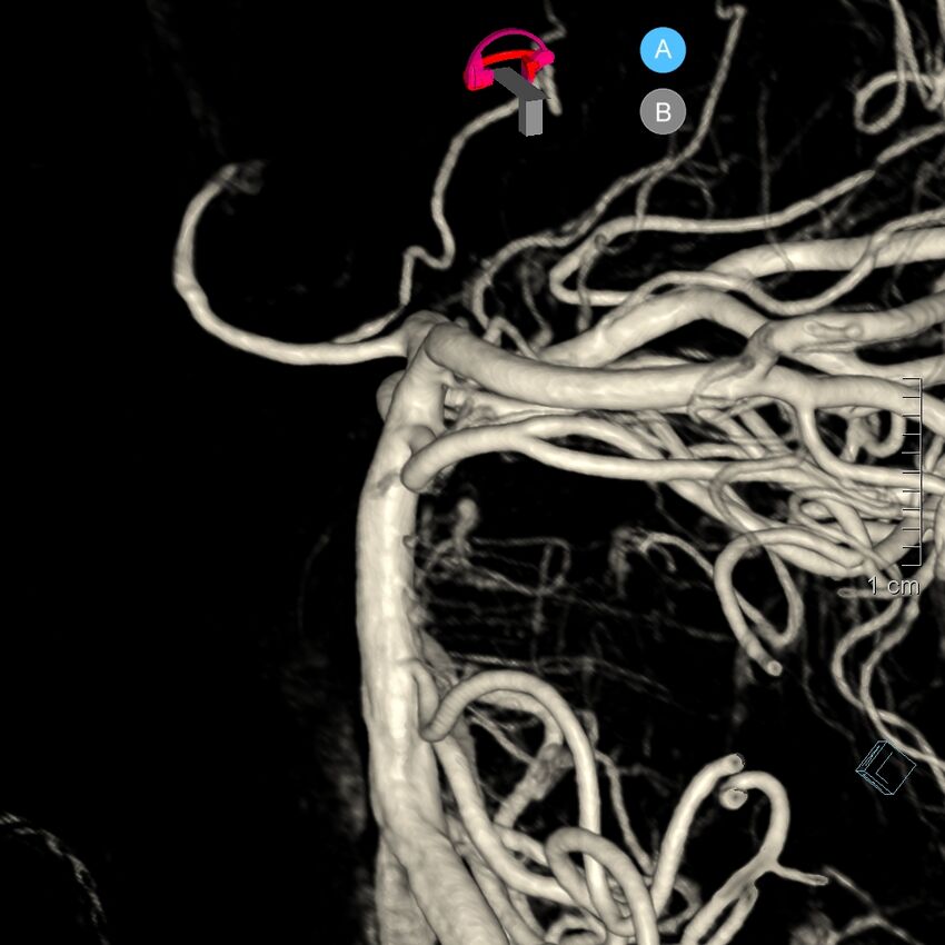 Basilar artery perforator aneurysm (Radiopaedia 82455-97734 3D view left VA 95).jpg