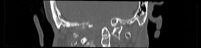 Basilar impression (Radiopaedia 52411-58522 Coronal bone window 126).jpg
