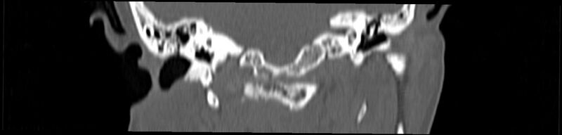 File:Basilar impression (Radiopaedia 52411-58522 Coronal bone window 87).jpg