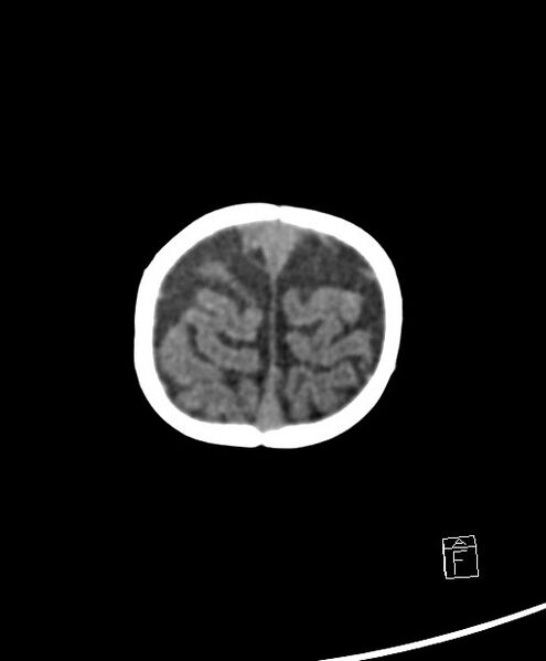 File:Benign enlargement of subarachnoid spaces in infancy (BESS) (Radiopaedia 87459-103795 Axial non-contrast 7).jpg