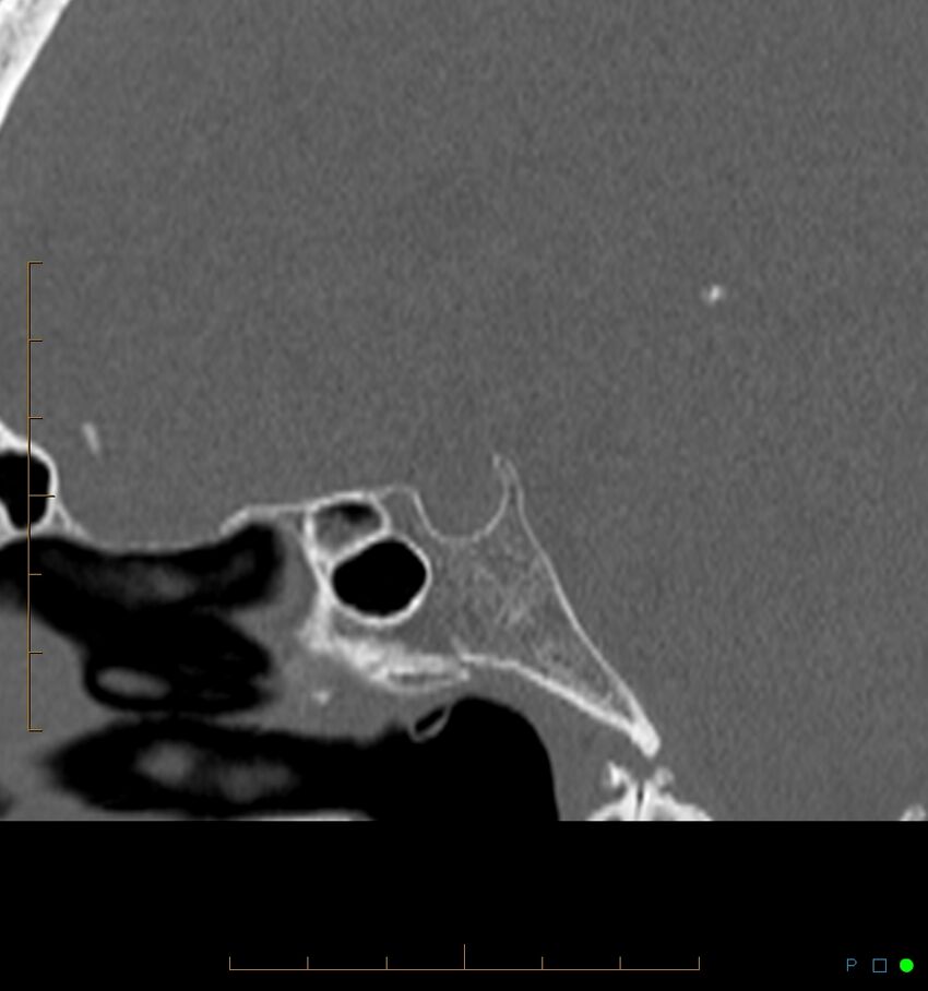 Benign notochordal cell tumor (probable) (Radiopaedia 65475-74546 Sagittal bone window 21).jpg